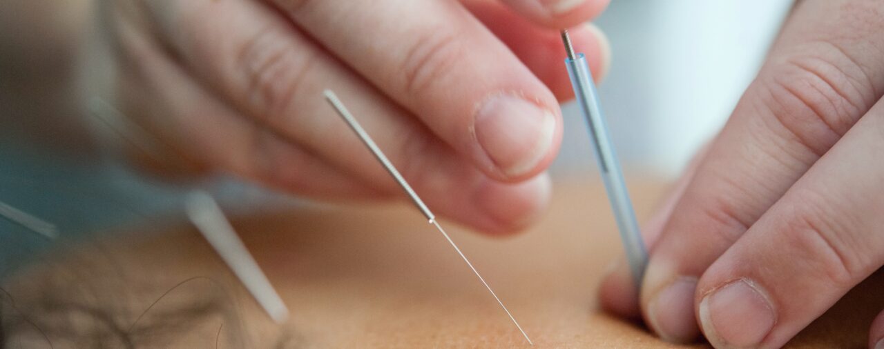 Getting to Know Acupuncture and Acupressure